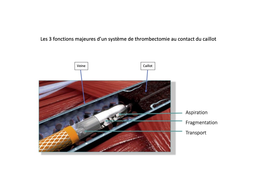 Thrombectomie mecanique