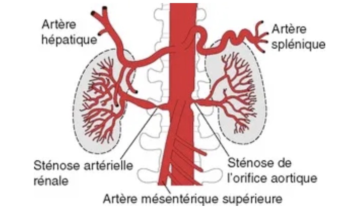 sténose artère rénale - Macirculation