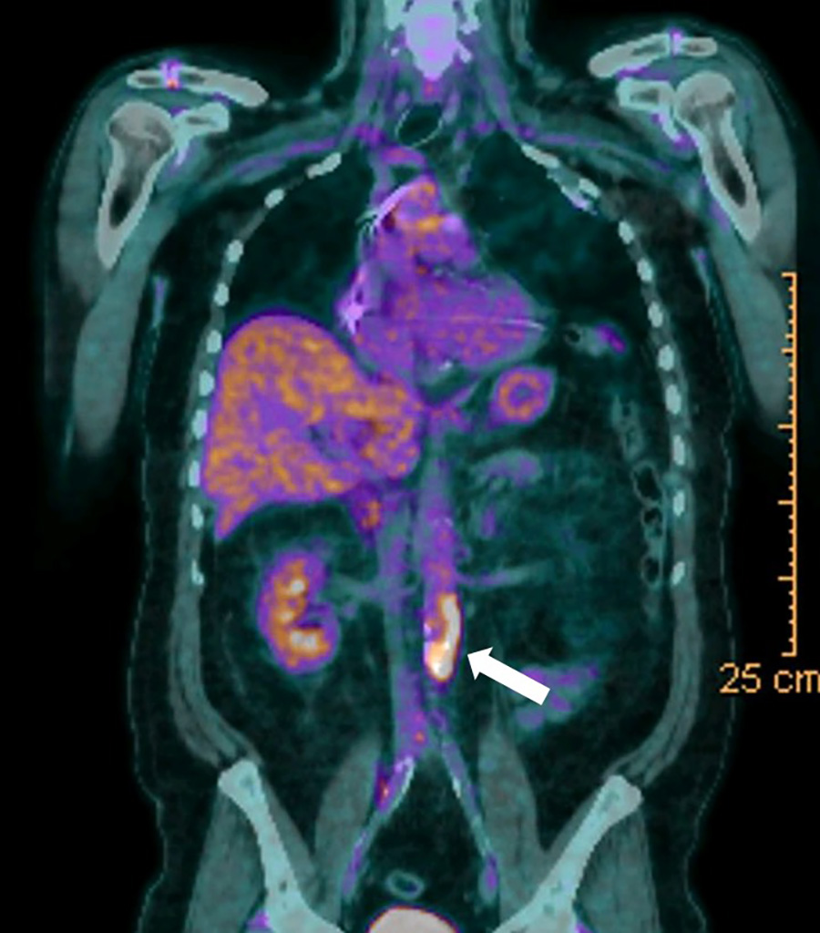 pet scan ao