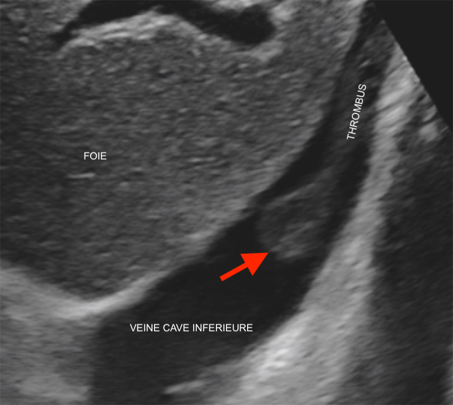 thrombus veine cave