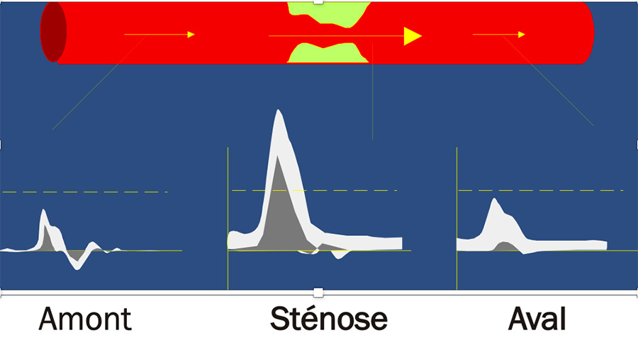 variation flux stenose
